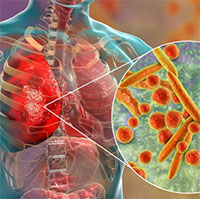 Viêm phổi do Mycoplasma: Nguyên nhân,triệu chứng và cách điều trị 