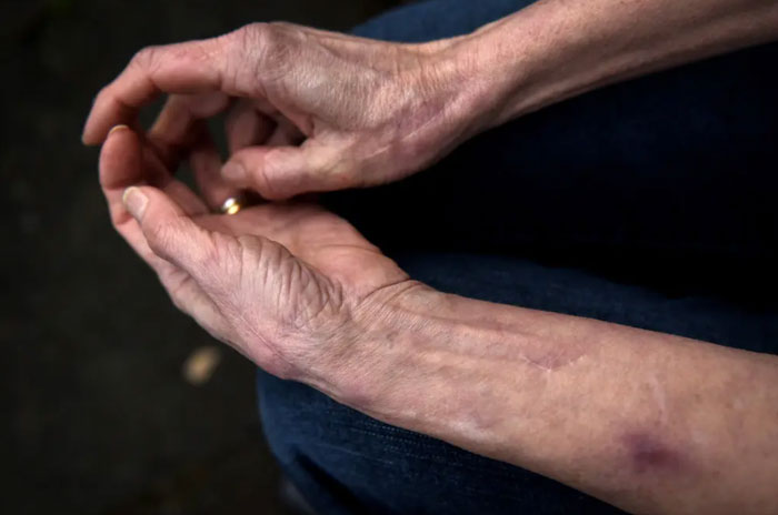 Cụ bà 75 tuổi chưa từng cảm thấy đau đớn hay sợ hãi nhờ gen hiếm