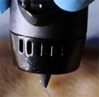Các chuyên gia Trung Quốc phát triển bút công nghệ cao phun gel chữa lành vết thương