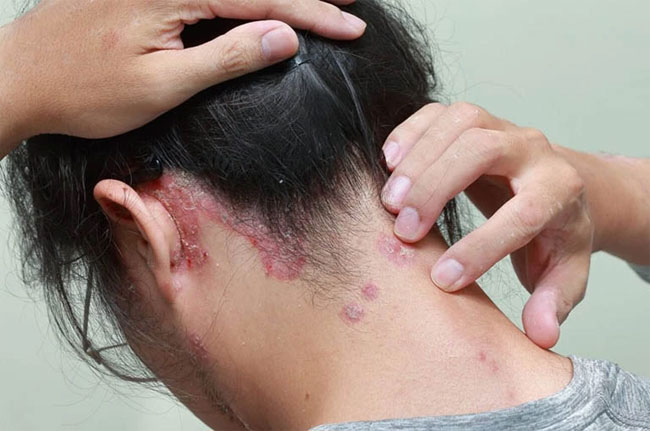 Mùa mưa, cẩn trọng loạt hệ lụy sức khỏe kéo theo khi dùng mũ bảo hiểm, áo mưa ẩm hôi