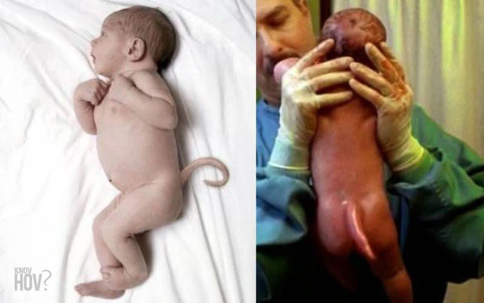 Tại sao một số người sinh ra có đuôi như động vật?