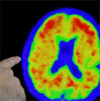 Thuốc donanemab - đột phá trong việc điều trị bệnh Alzheimer 