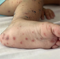 Vaccine phòng tay chân miệng đầu tiên ở Việt Nam có hiệu quả 96,8%