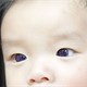 Sau điều trị Covid-19, em bé mắt nâu biến thành mắt xanh