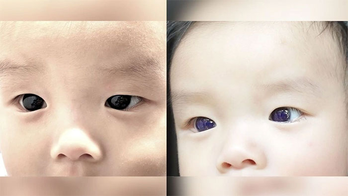  Bình thường em bé có đôi mắt màu nâu (ảnh trái) và chuyển thành mắt xanh (ảnh phải) 