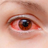 Nhìn người đau mắt đỏ có lây không?