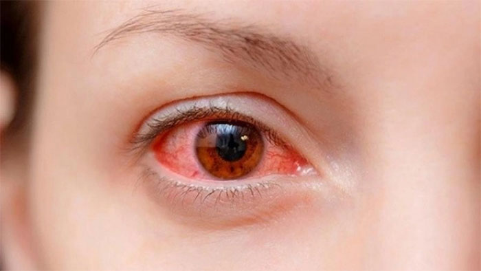 Nhìn người đau mắt đỏ có lây không?