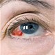 Đột quỵ mắt: Nguyên nhân, triệu chứng và cách điều trị