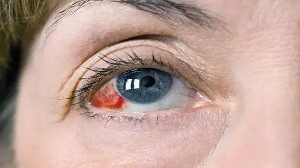 Đột quỵ mắt xảy ra khi các tĩnh mạch hoặc động mạch của võng mạc bị tắc nghẽn