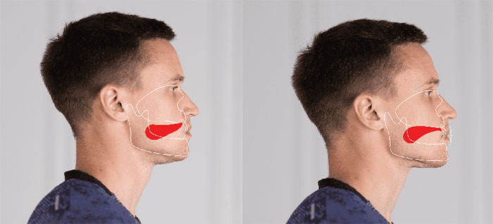 Mewing là một kỹ thuật sử dụng vị trí của lưỡi để định hình đường viền hàm và khuôn mặt.