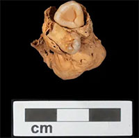 Khối u quái chứa răng trong hài cốt 3.000 năm