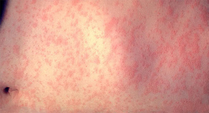 Các loại bệnh lây truyền qua đường không khí