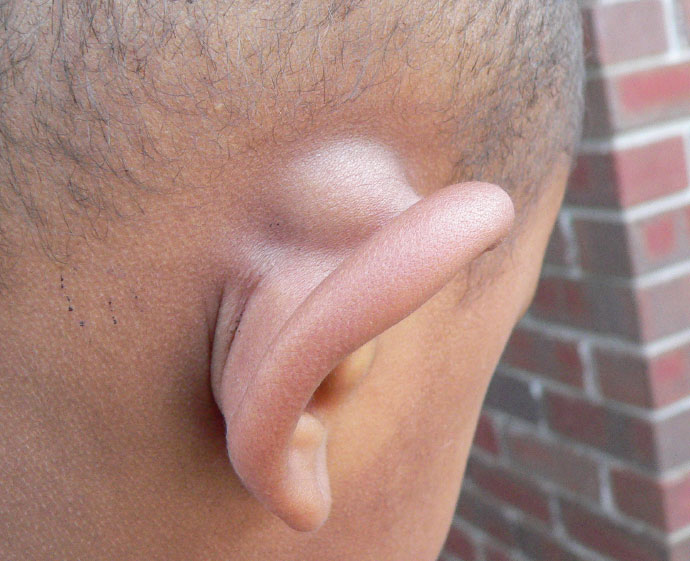 U mỡ sau tai, khi chạm vào mềm và nhão.