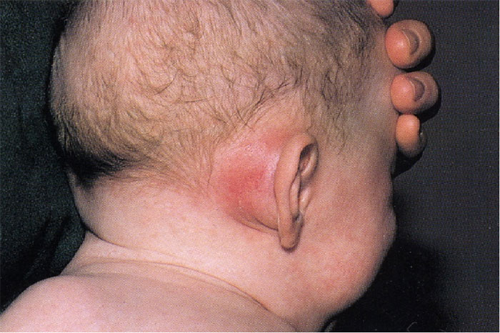 U cục sau tai do viêm xương chũm thường xảy ra ở trẻ em.