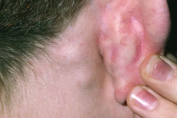 U cục sau tai có thể do nhiễm trùng