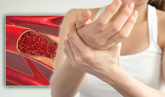 Chân hoặc tay bị sưng tấy là triệu chứng phổ biến khi phát hiện cục máu đông