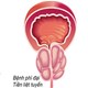 Phì đại tiền liệt tuyến: Nguyên nhân, triệu chứng và cách điều trị