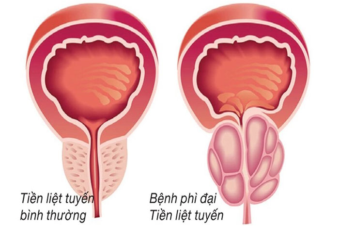 Phì đại tiền liệt tuyến: Nguyên nhân, triệu chứng và cách điều trị