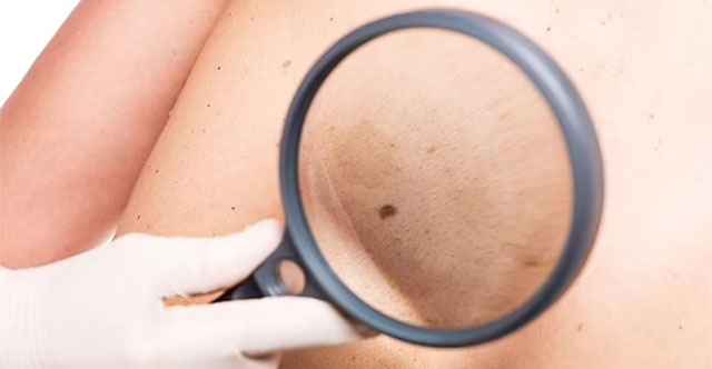 Công nghệ mới trên điện thoại 6G có thể giúp phát hiện sớm ung thư da
