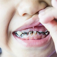 Vì sao trẻ con luôn bị sâu răng?