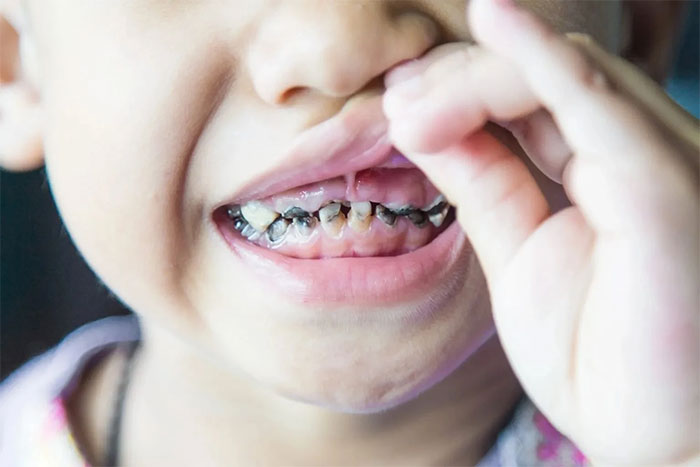 Vì sao trẻ luôn bị sâu răng?