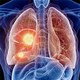Tìm ra lý do khiến ngày càng nhiều người trẻ bị ung thư