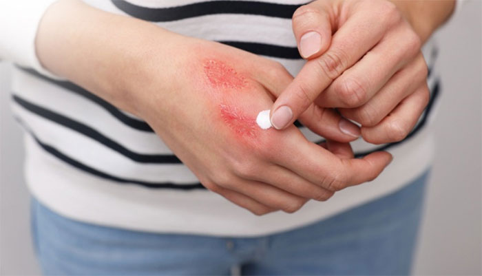 Cách xử lý vết thương do kiến ba khoang gây ra đơn giản mà nhanh