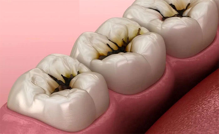 Bệnh viêm xương hàm: Nguyên nhân, triệu chứng và cách điều trị