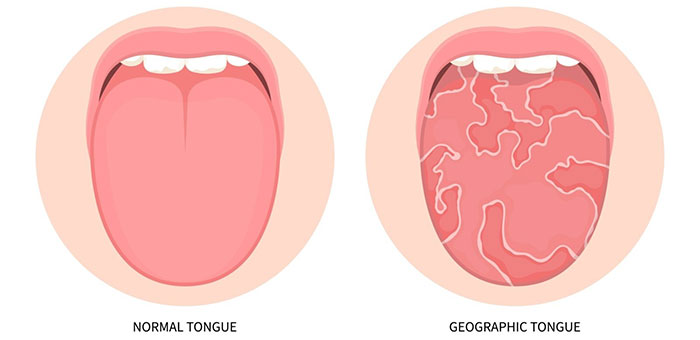 Lưỡi bản đồ là tình trạng bề mặt lưỡi xuất hiện những mảng màu đỏ và trắng xen kẽ nhau