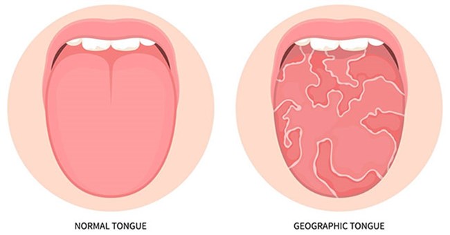 Những đặc điểm kỳ lạ của lưỡi người: Hiện tượng lưỡi xúc tu, lưỡi bản đồ và lưỡi nứt
