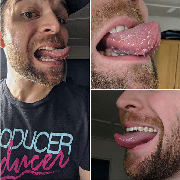 Lưỡi xúc tu là tình trạng các nhú lưỡi (những gai nhỏ trên bề mặt lưỡi) phát triển quá mức